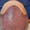 Transform Your Look with the No.1 Hair Transplant Clinic in Thane